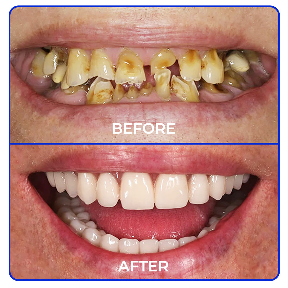 🤍🦷 Furzero® Focussmile bee venom treatment powder for oral use🦷