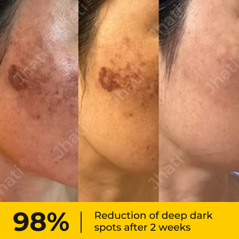 Jhati® MicroNeedle & Melazero V2 Dark Spot Brightening Cream