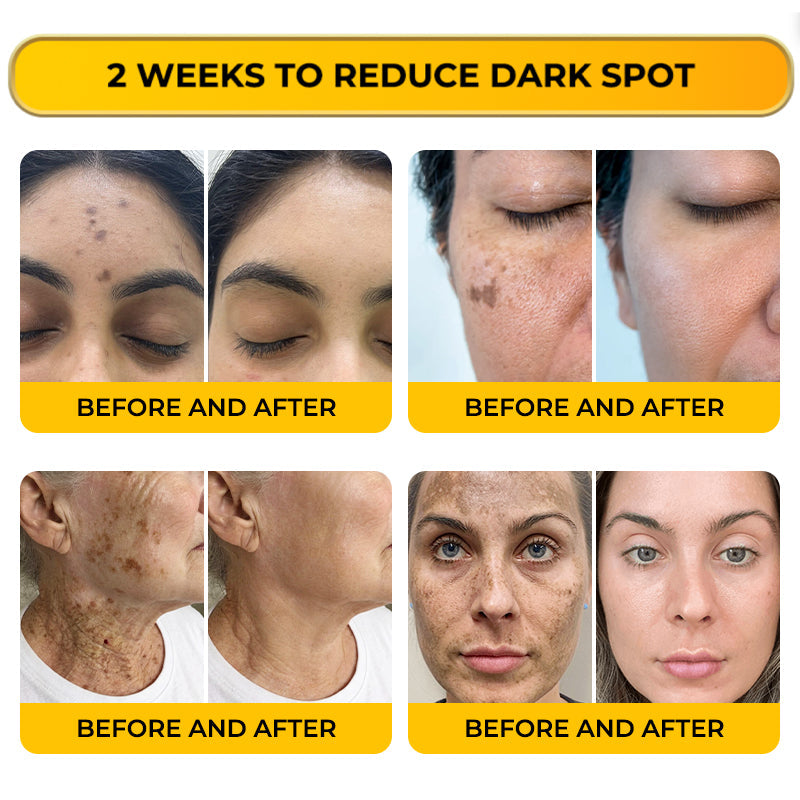 Jhati® MicroNeedle & Melazero V2 Dark Spot Brightening Cream