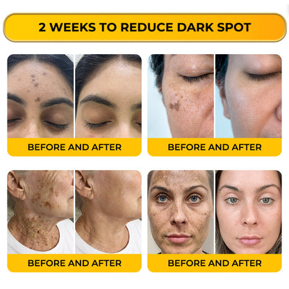Jhati® MicroNeedle & Melazero V2 Dark Spot Brightening Cream