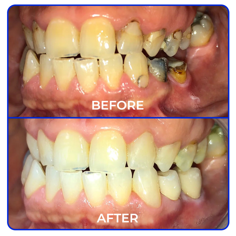 🤍🦷 Furzero® Focussmile bee venom treatment powder for oral use🦷