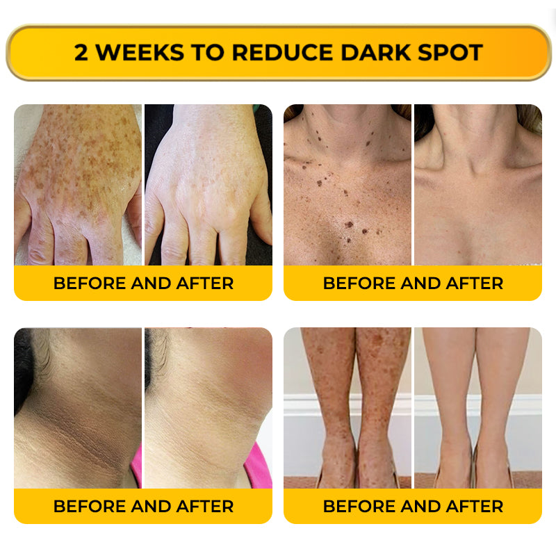 Jhati® MicroNeedle & Melazero V2 Dark Spot Brightening Cream