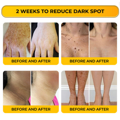 Jhati® MicroNeedle & Melazero V2 Dark Spot Brightening Cream