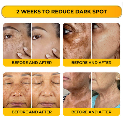 Jhati® MicroNeedle & Melazero V2 Dark Spot Brightening Cream