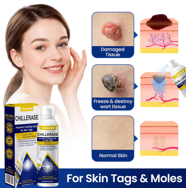 Celsiora® ChillErase Cooling Spray for Skin Tags