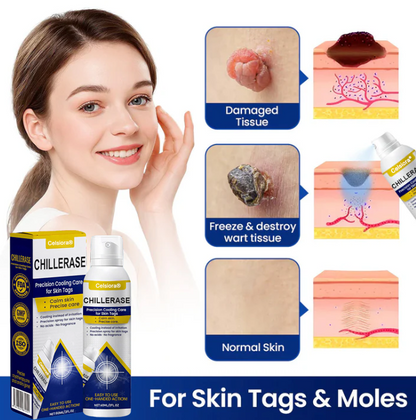 Celsiora® ChillErase Cooling Spray for Skin Tags