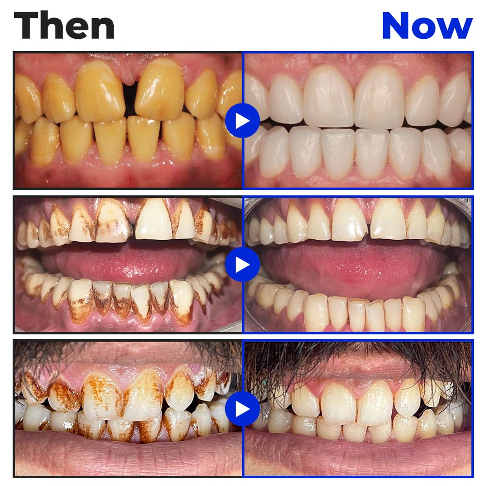 🤍🦷 Furzero® Focussmile bee venom treatment powder for oral use🦷