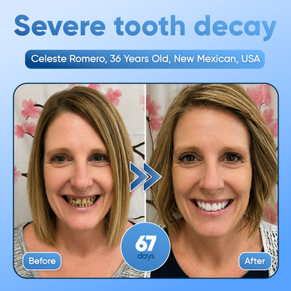 ⭐️Tideglusib Fast‑Dissolving Tooth & Gum Repair Oral Strips