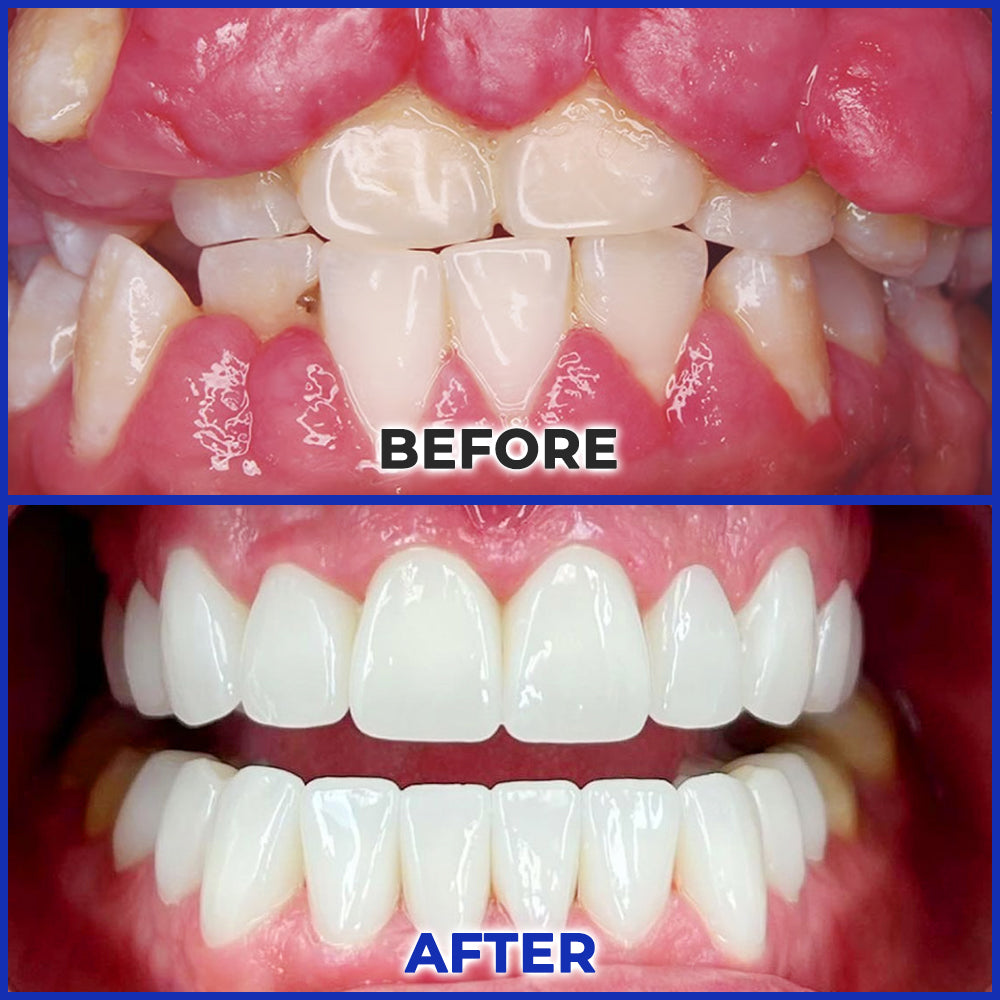 Rolimey® MicroSmile Bee Venom Dental Treatment Ultra-fine Foam Toothpaste with Tongue Scraper