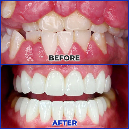 Rolimey® MicroSmile Bee Venom Dental Treatment Ultra-fine Foam Toothpaste with Tongue Scraper