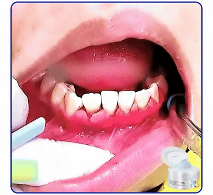 ⭐️Furzero® Focussmile bee venom treatment powder for oral use🦷