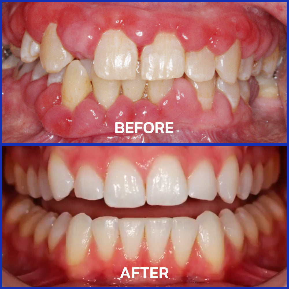 🇬🇧👨🏼‍⚕️Rolimey® VioGloss Bee Venom Dental Therapy Oral Power🦷