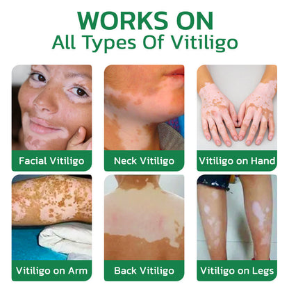 Jhati® TreatVitiligo Soothing Cream