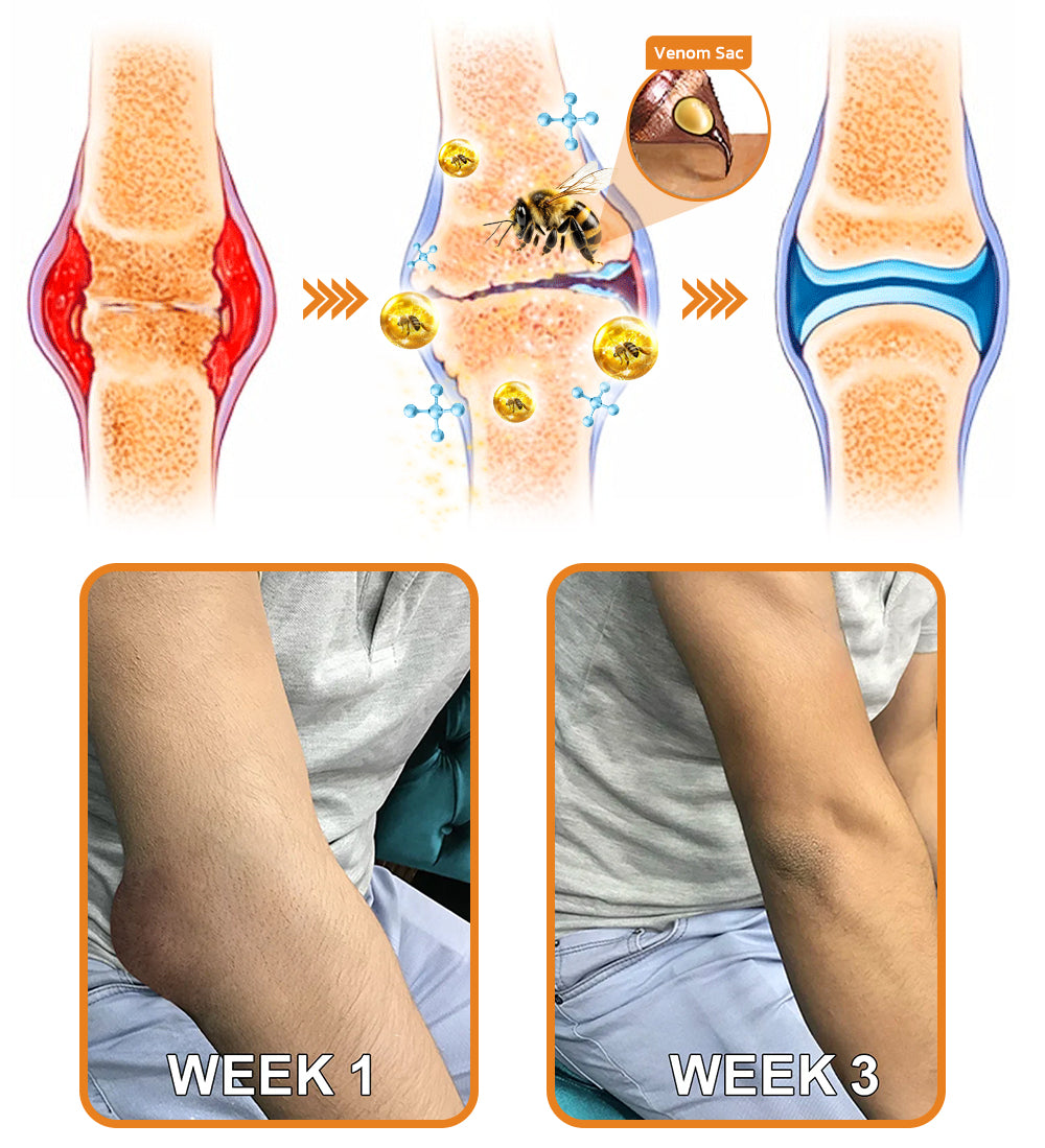🇺🇸Official Store: flysmus® Bee-Venom Pain-Relief Bone Healing Cream👨‍⚕️FDA Certified